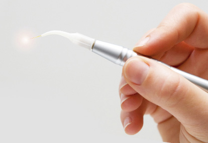 cancun dental design´s dentist using a laser for gum contouring