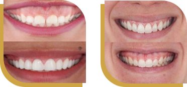 Cancun dental design´s patient before and after gum contouring