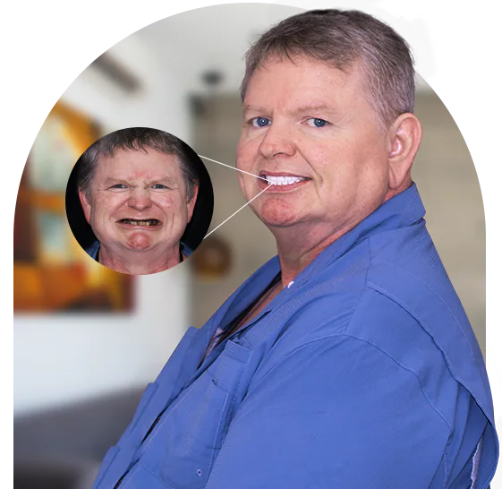 before and after picture of a cancun dental designs patient who got teeth bone graft