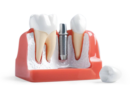 can get dental implants right after bone graft