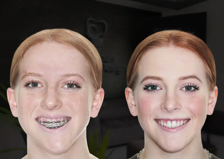 young patient at cancun dental design face change after her orthognathic surgery in mexico
