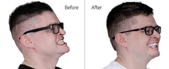 Overbite surgery before and after pictures of a patient at cancun dental design