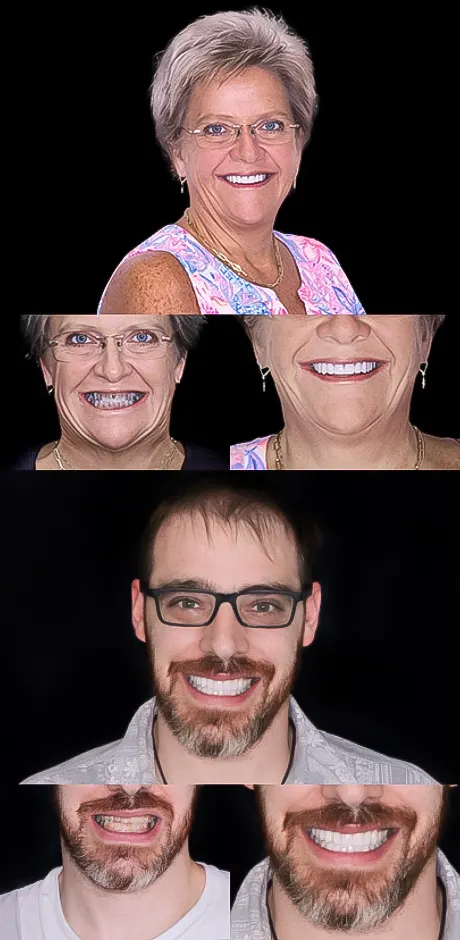 smile makeover before and after pictures from cancun dental design patients