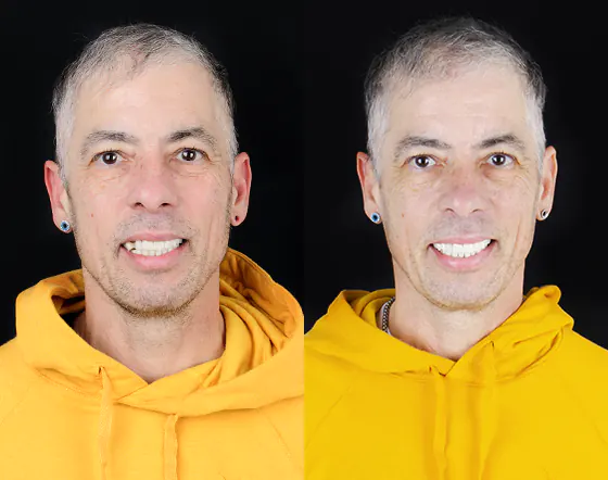 example of dental crowns used in a full smile makeover in Mexico