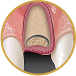representation of a socket graft after a tooth extraction