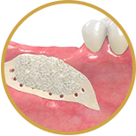 example of a block bone graft procedure