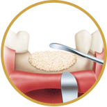 3D representation of a ridge bone graft