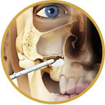 viasual example of a sinus lift procedure for dental implants