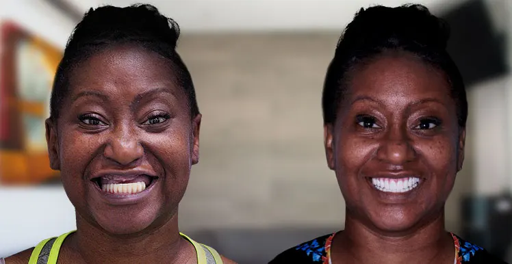 before and after pictures of black woman with an all-on 4 denture with zygomatic implants