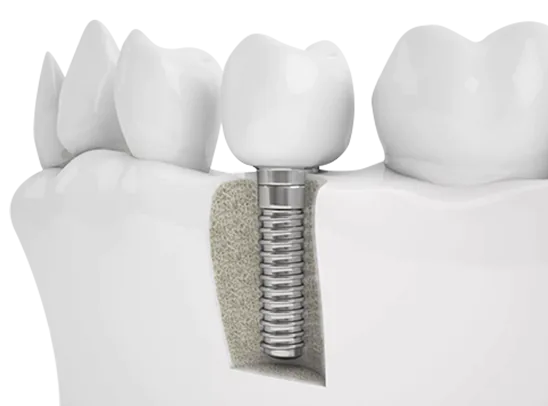 dental bone graft implant