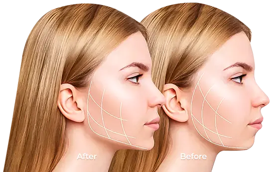 before and after comparison to explain what is orthgnathic surgery