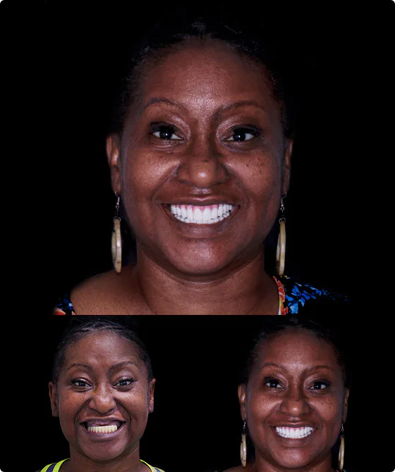 before and after pictures of a patient at Cancun dental design who had dental bone grafts to get dental implants