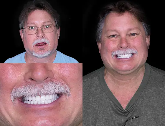 before and after pictures of an elder patient who got zygomatic dental implants in Mexico