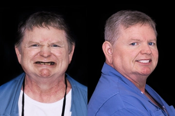 patient with a snap-in dentures in mexico