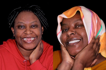 patient with a snap-in dentures in mexico