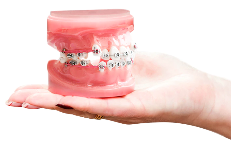 the benefits of orthodontic braces