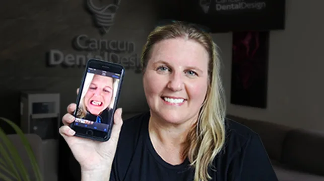 before and after in Cancun Dental Design