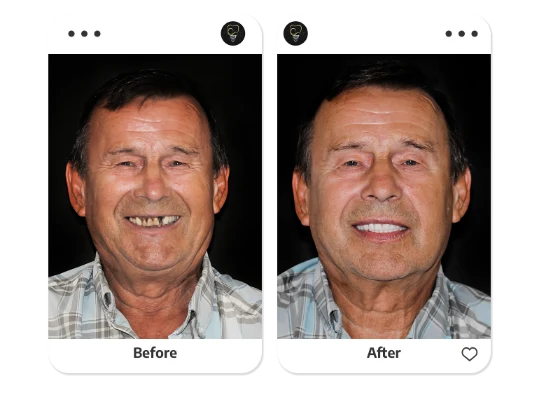 patient with a snap-in dentures in mexico