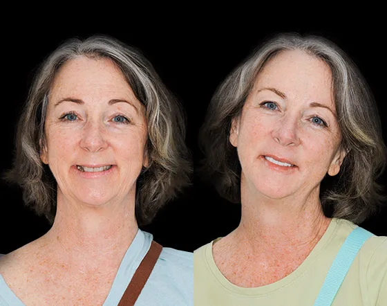 cancun dental design´s patient porcelain crowns
before and after pictures