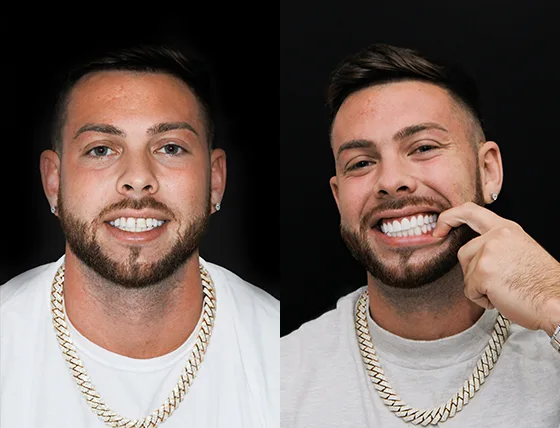 before and after pictures of cancun dental design patients who had
composite and porcelain veneers