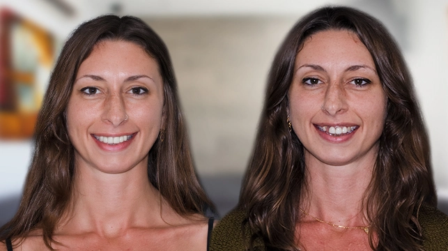 before and after photo of your dental crowns dental procedure in Cancun, Mexico