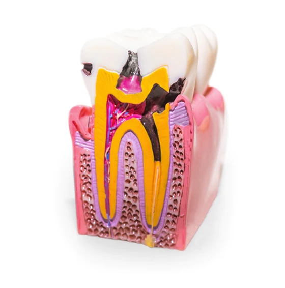 root canal therapy aftercare