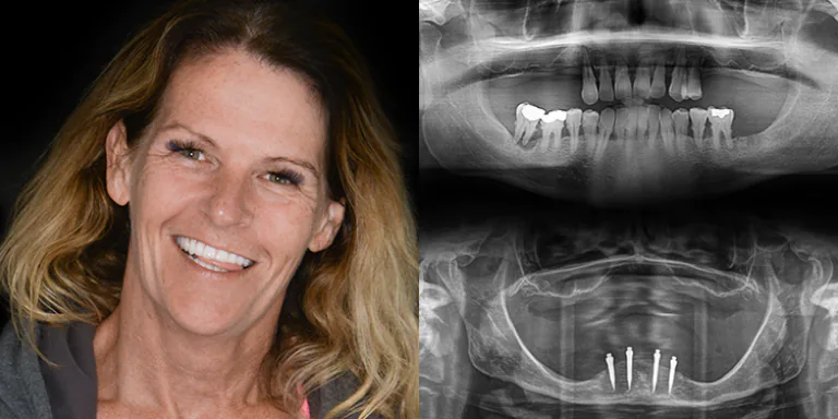 snap on dentures with mini dental implants