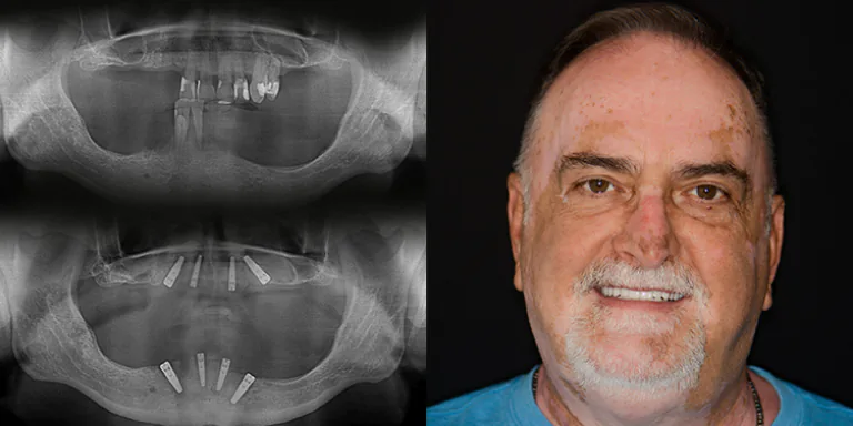 snap on dentures with regular dental implants