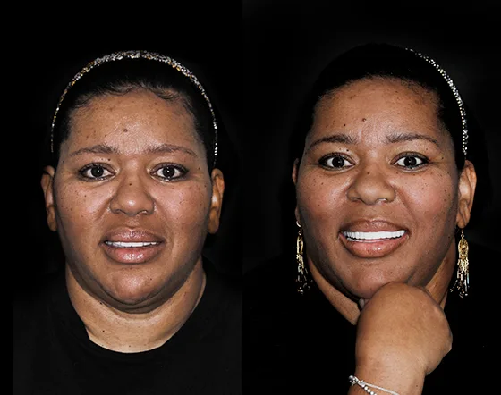 cancun dental design´s patient zirconia crowns
before and after pictures
