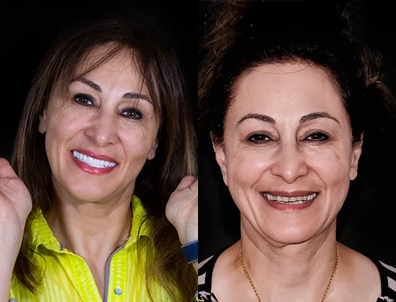 before and after patientsof cancun dental design patients who had composite and porcelain veneers