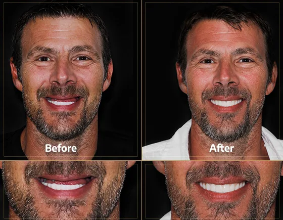 cost of full-moth dental implants in Mexico