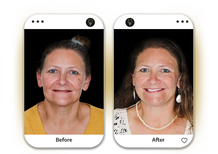 patients results in cancun dental design, mexico