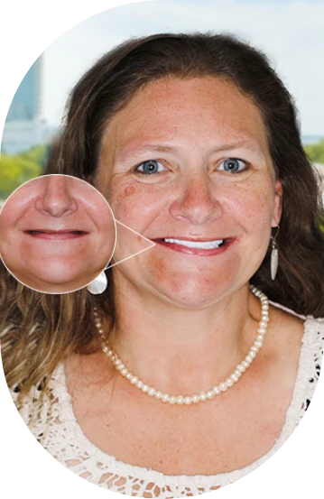 elder patient of cancun dental design with all on 4 zirconia dental implants
