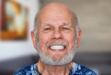 man with zygomatic dental implants in mexico