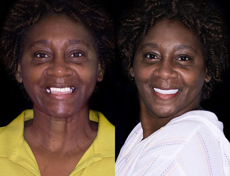 suitable candidate for 3 on 6 dental implants