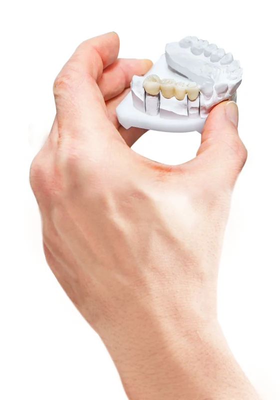 the benefits of getting 3 on 6 dental implants