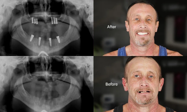 dental impalnts all on 4 in cancun dental design
