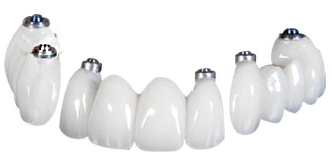 what are the 3 on 6 dental implants