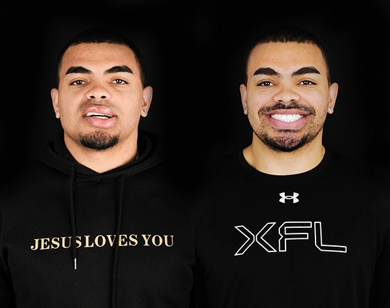 cost of dental veneers in Mexico, before and after