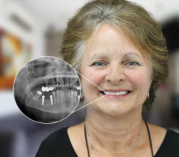 X ray of a patient implant-fixed dental bridge