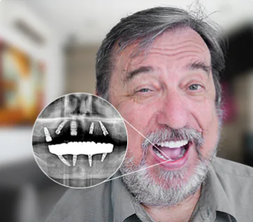 X ray of a patient implant fixed denture