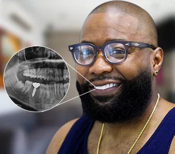 X ray from a patient with a single dental implant and crown