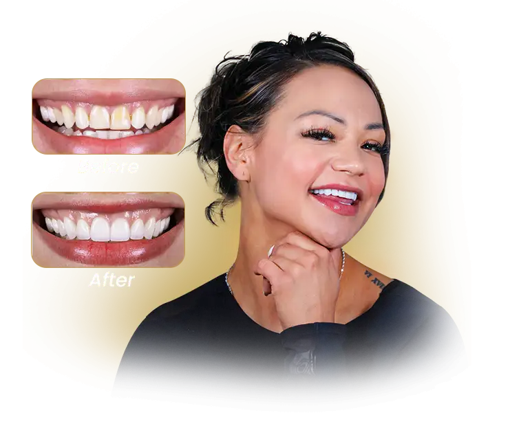 female patient with veneers in mexico