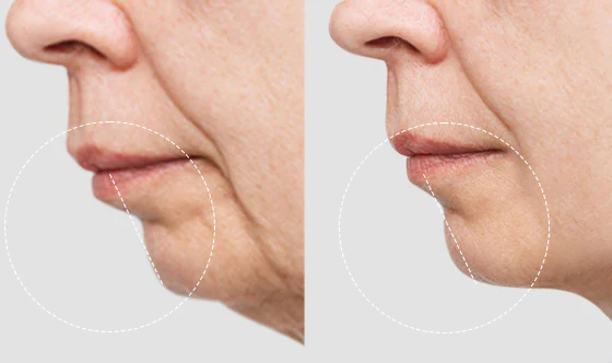 double jaw surgery before and after of a cancun dental desing n´s elder woman patient