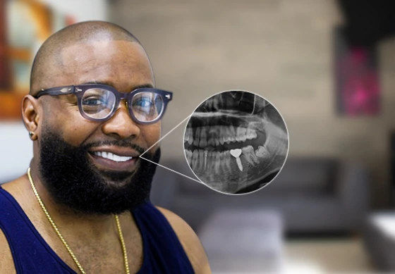 X-ray caption of a cancun dental design clinic patient who got a dental implant with a crown