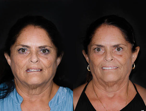 patient at cancun dental design root canal therapy before and aftter