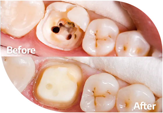 root canal before and after results