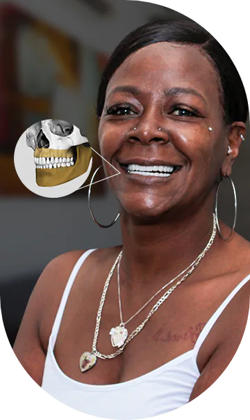 X-ray caption of a cancun dental design clinic patient who got a dental implant with a crown