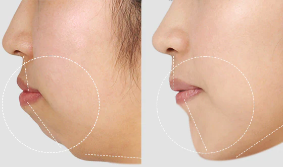 Triple jaw surgery before and after of a cancun dental desing n´s young woman patient