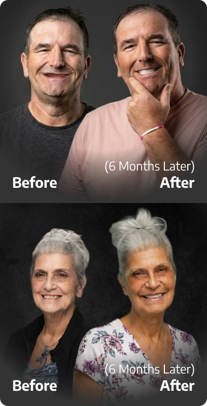 Dual before and after dental transformation: a senior Caucasian man and a senior caucasian woman showing the 6-month progress of full-mouth dental implant restorations, from missing teeth to confident, natural-looking smiles and a gorgeus tanned skin.